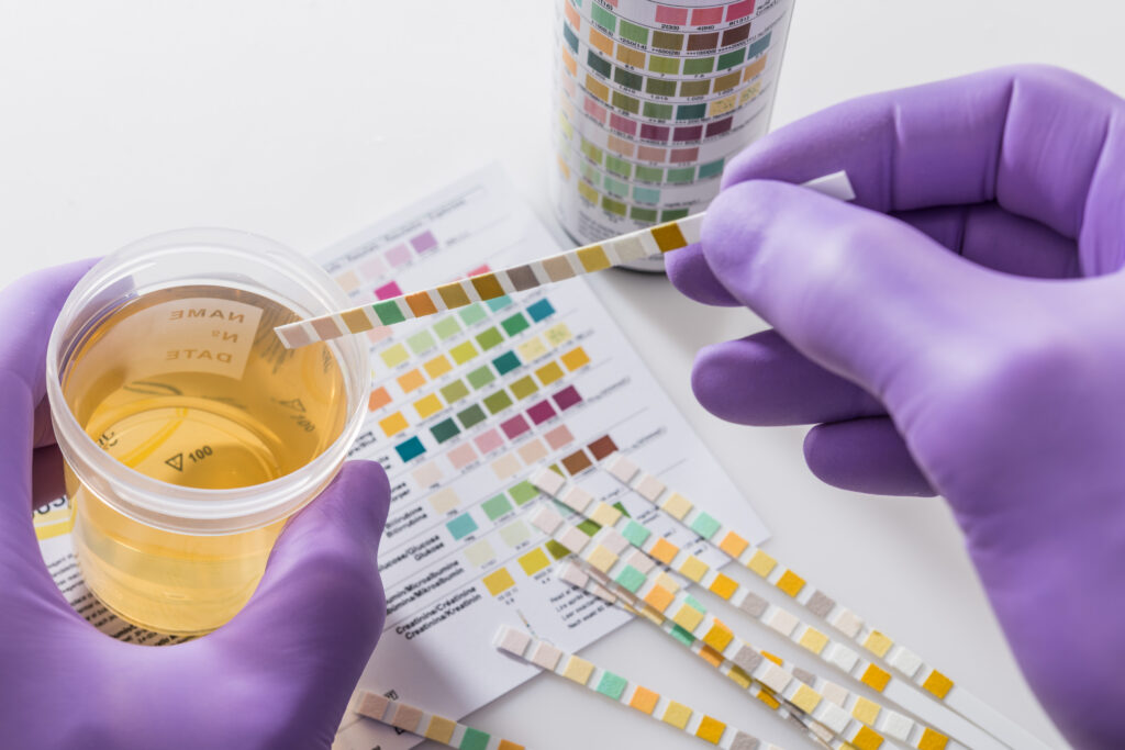 How Long Does Oxycodone Stay in Your Urine